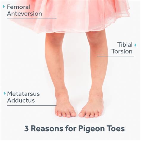 pigeon toed in children.